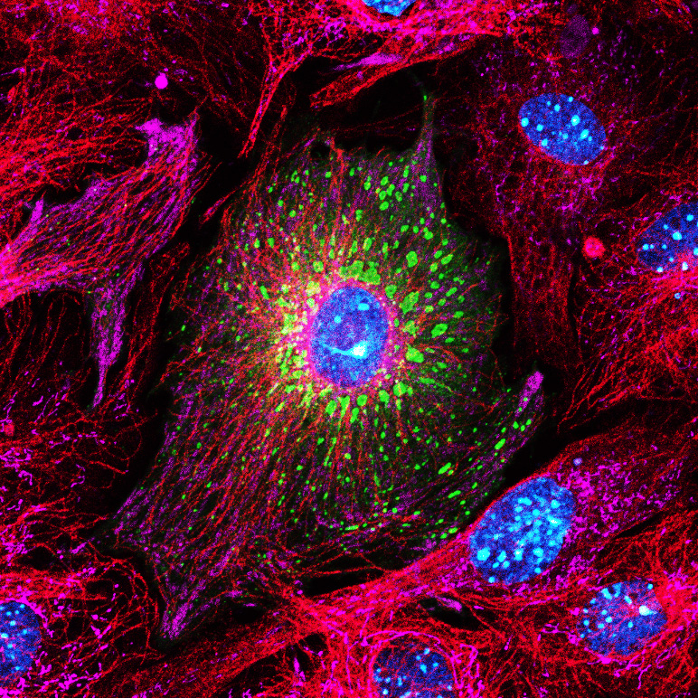 cardiac viral infection